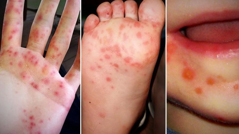 Bệnh Tay - Chân - Miệng và cách phòng bệnh