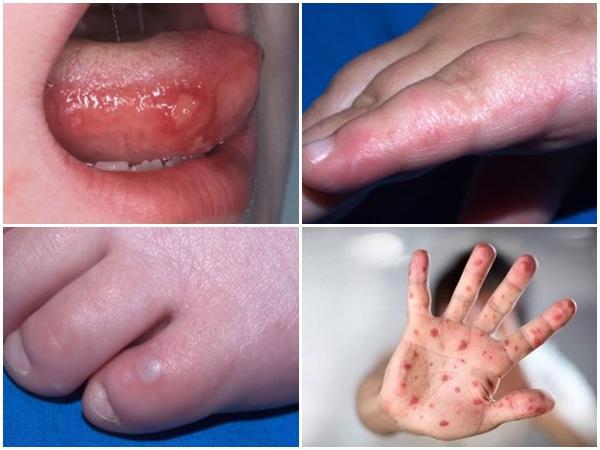Bệnh Tay Chân Miệng, Cách chăm sóc và Phòng bệnh