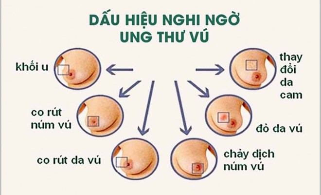 Dấu hiệu cảnh báo và cách phát hiện sớm ung thư vú